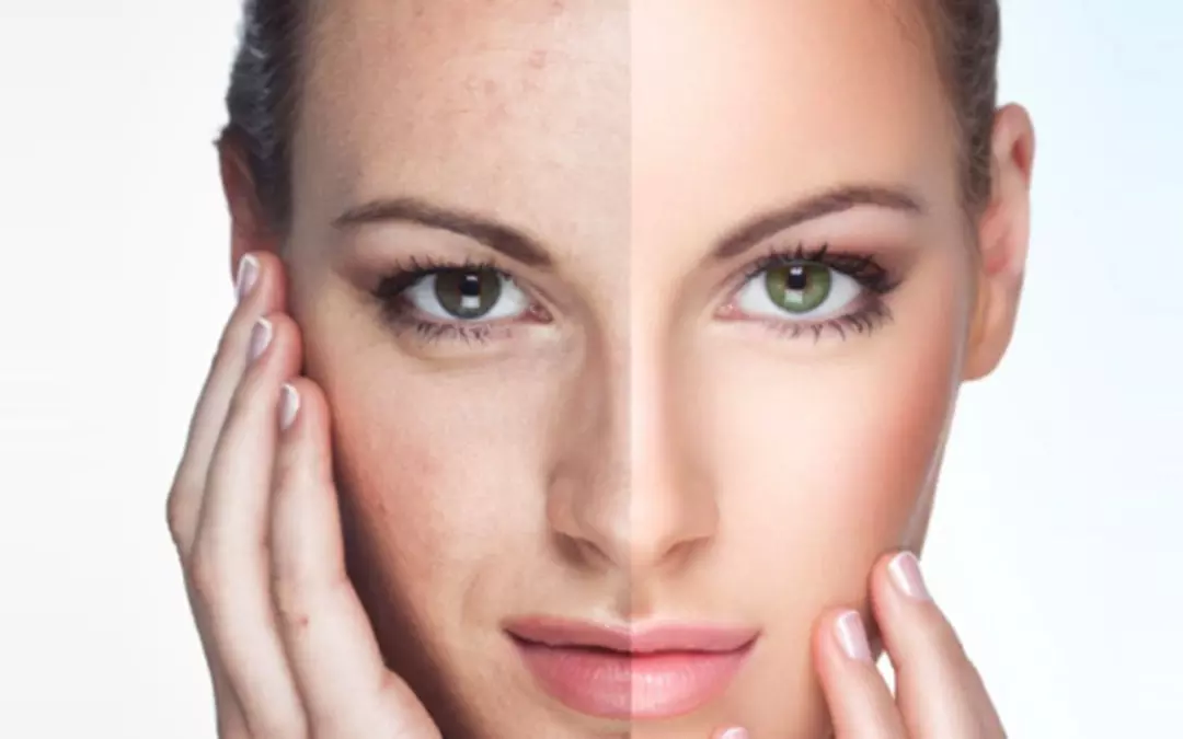 Ultimate Guide to Facial Rejuvenation