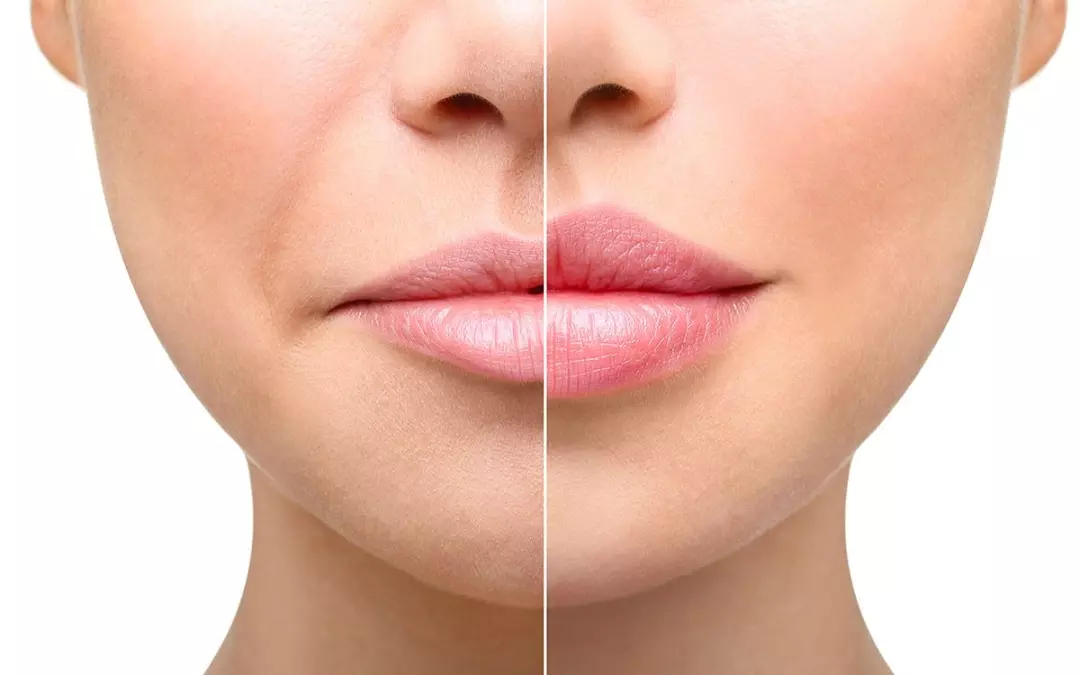 Explore the Best Natural Lip Fillers for Stunning Results