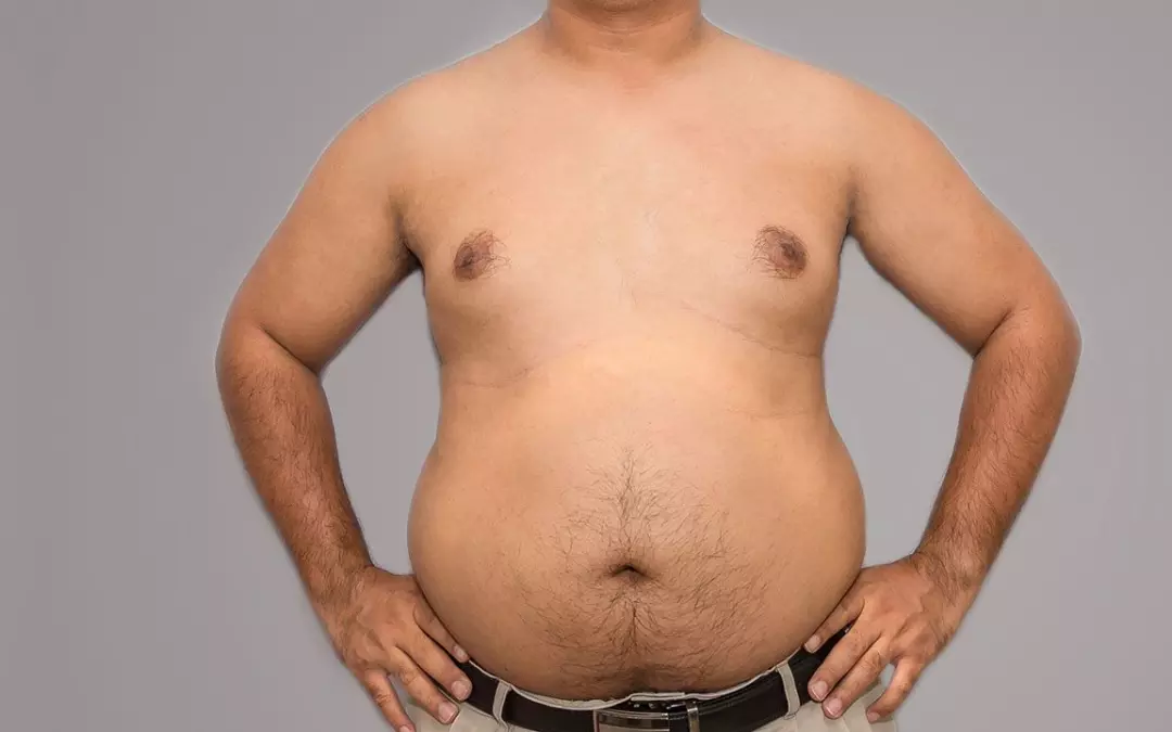 Comprehensive Guide to Men Chest Fat Removal Options