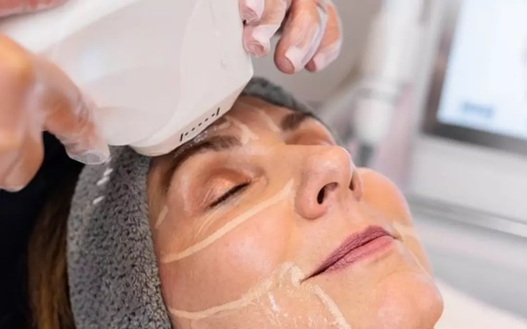 Hypho Face Lift: Your Guide to Ultrasound Facelifts