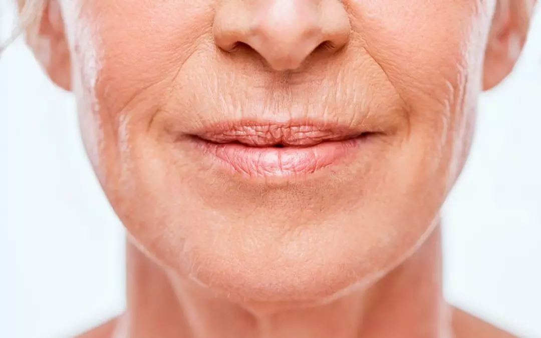 Comprehensive Guide to Laser for Smokers Lines Treatment