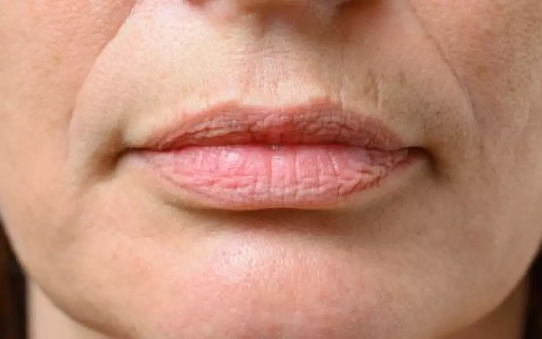 Microneedling for Marionette Lines: A Comprehensive Guide