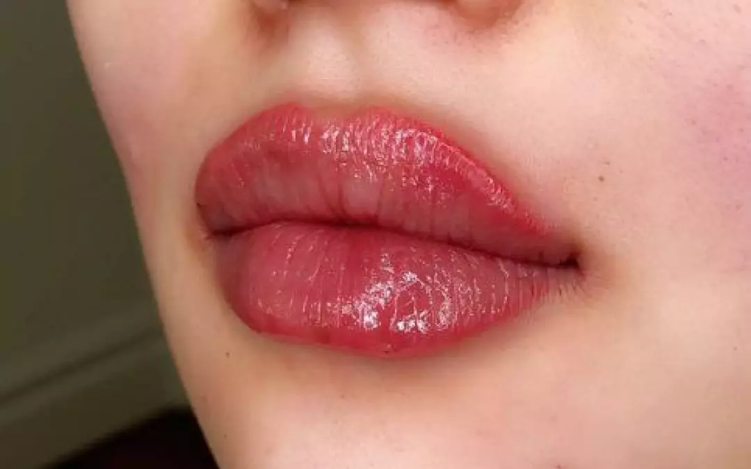 Russian Lip Fillers: Your Ultimate Guide