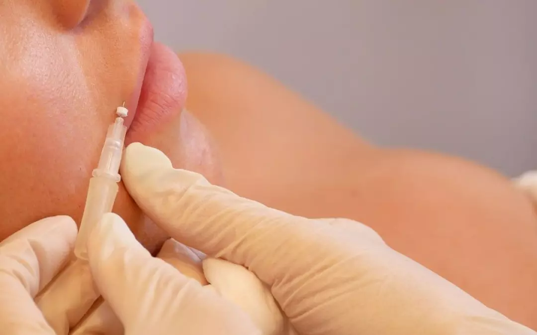 Unlock the Potential of PDO Lip Threads for Enhanced Beauty