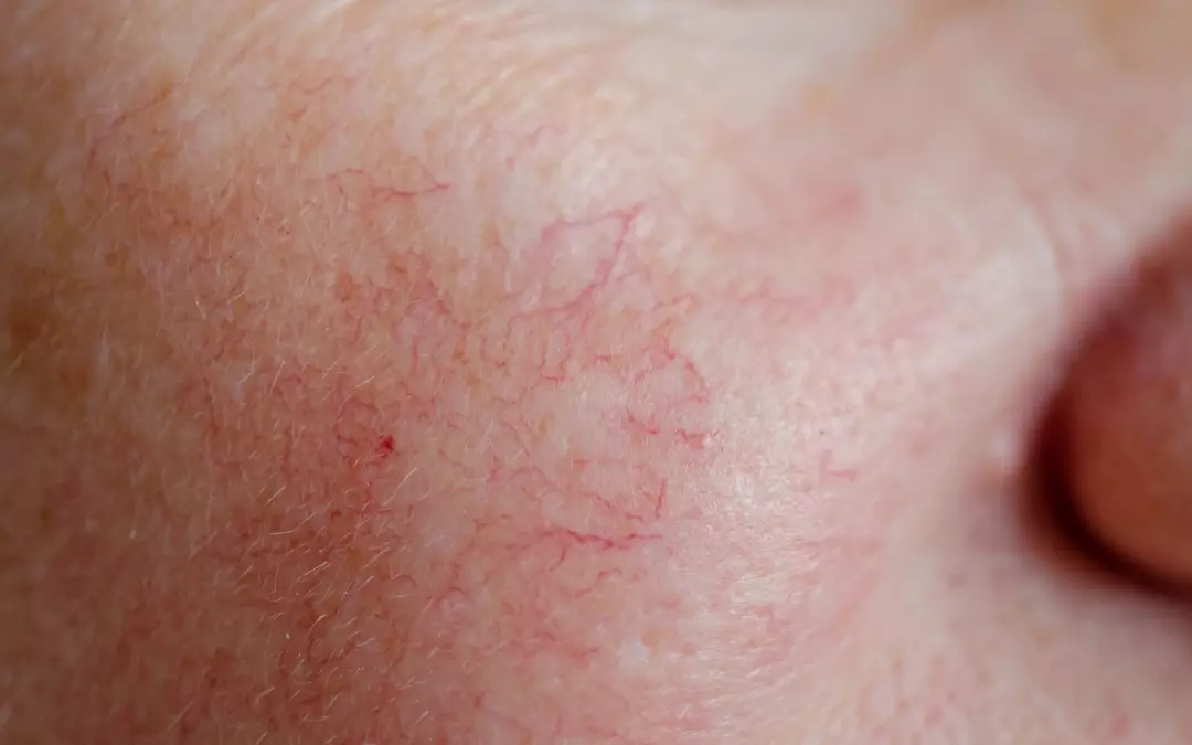Understanding and Managing Spider Vein on Face