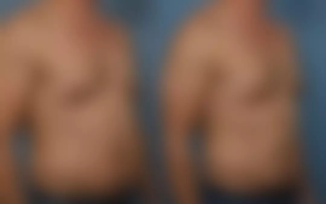 Understanding Men Breast Lift: A Comprehensive Guide