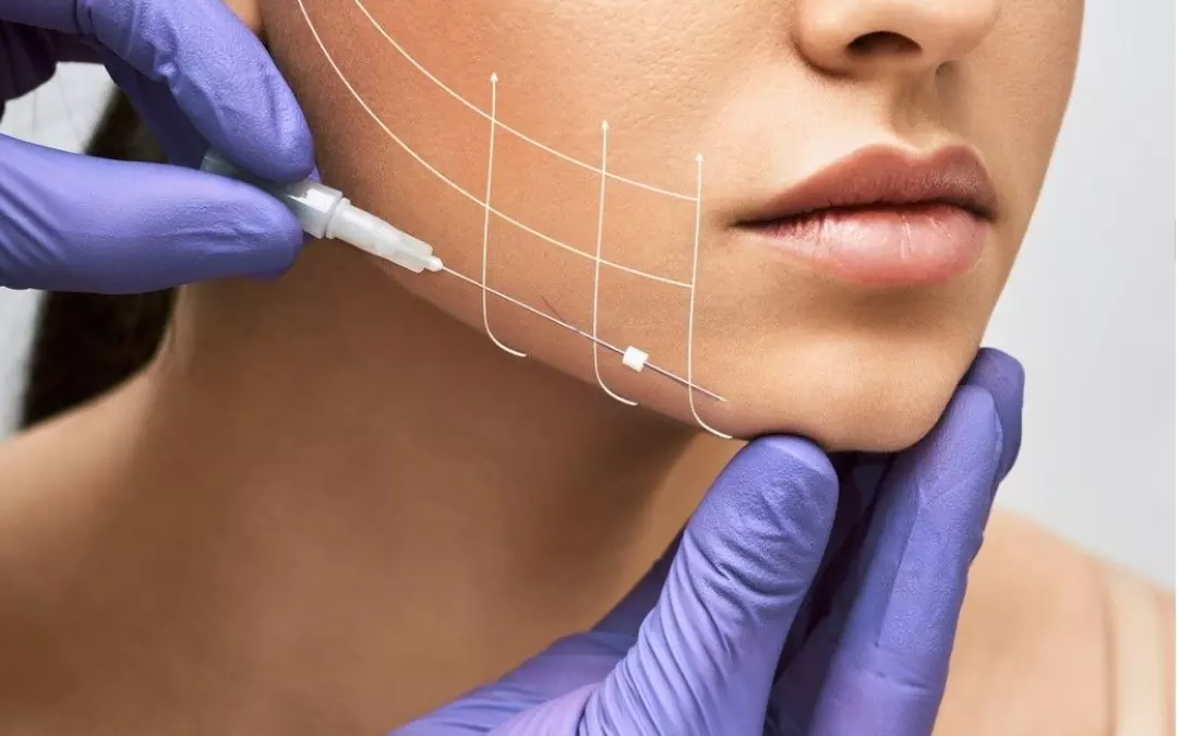 Understanding Collagen Threads Cost and Thread Lift Pricing