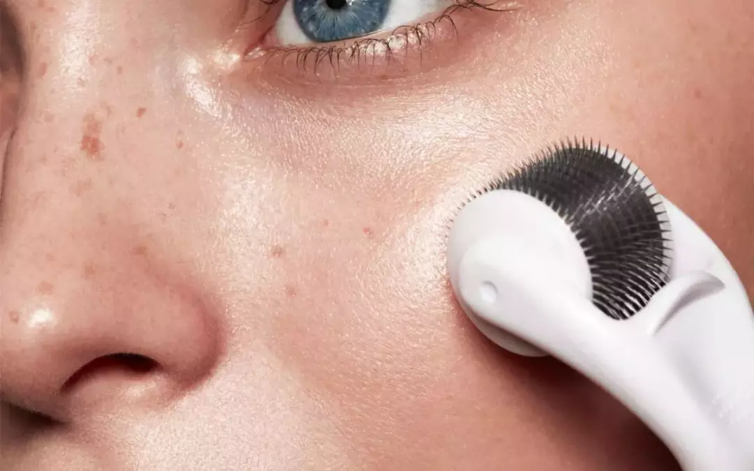 Effective Microneedling for Horizontal Neck Lines