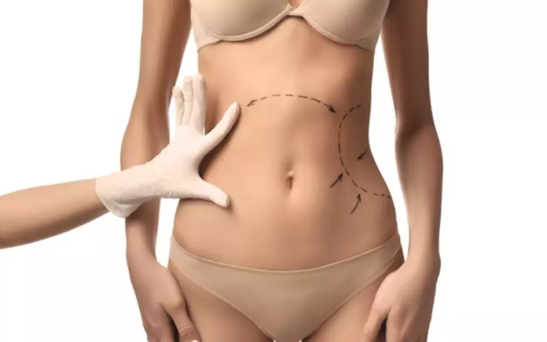 Revolutionising Body Contouring with Modern Liposuction