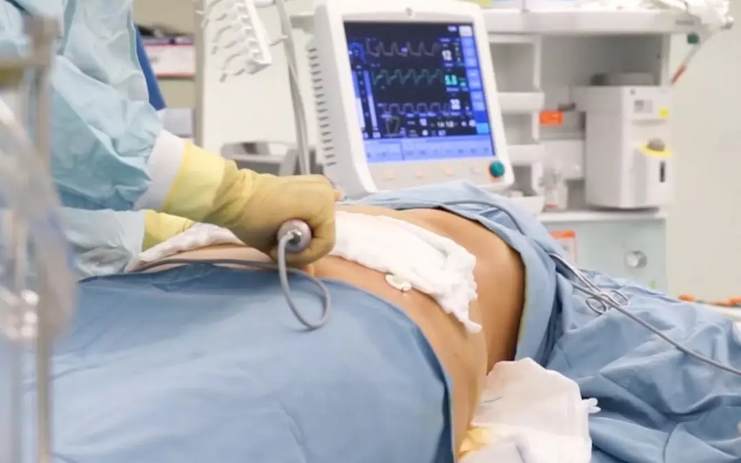 Understanding Non Surgical Liposuction Costs and Options