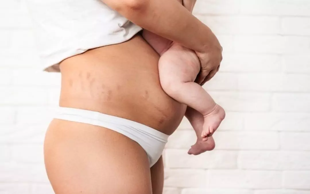 Lipo After C Section: A Comprehensive Guide for New Moms