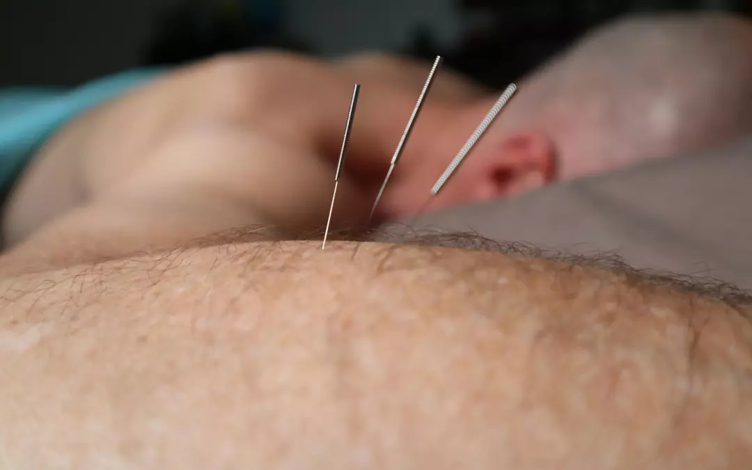 Agujas para bajar de peso: Un m&eacute;todo revolucionario