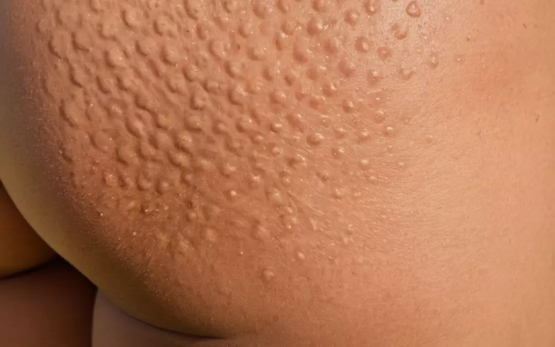 Gegen Cellulite: Top Tipps und Behandlungen