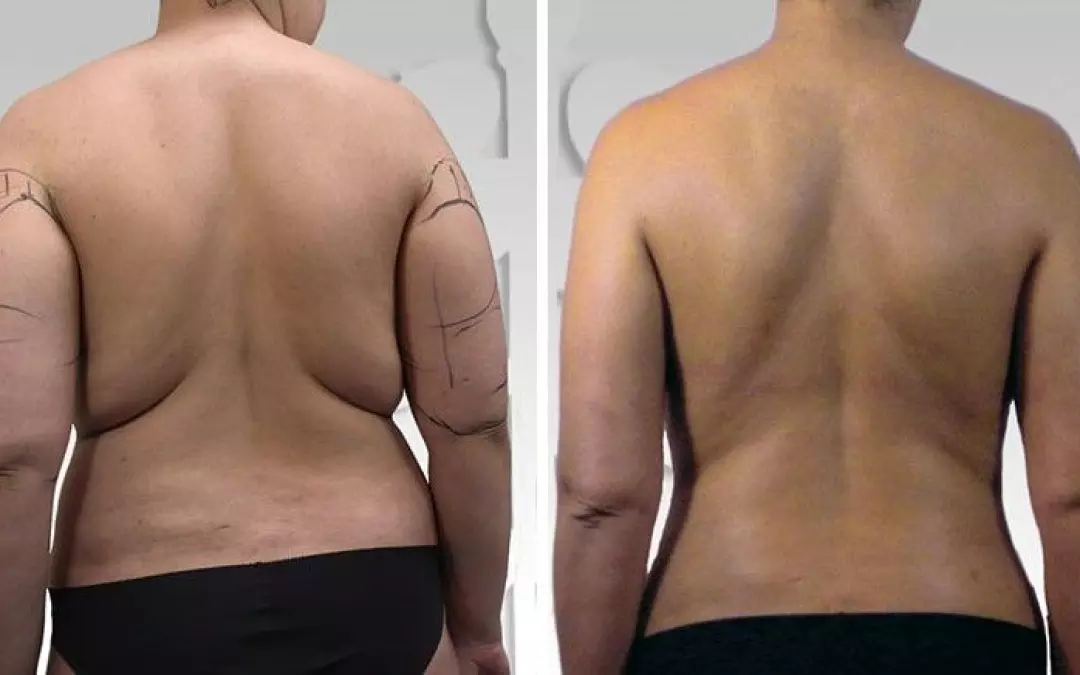 Comprehensive Guide to Liposuction on Arms and Back
