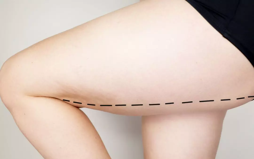 Comprehensive Guide to Mommy Makeover with Thigh Lift