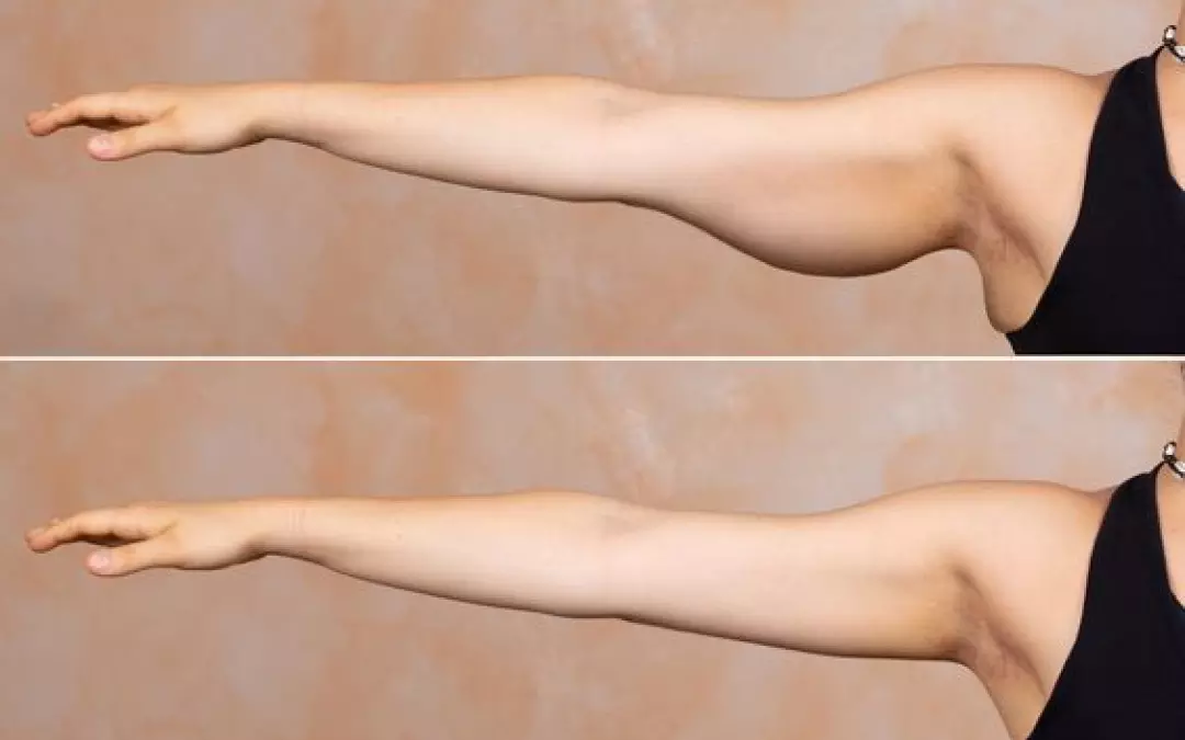 Exploring Surgery for Smaller Arms: Options and Insights