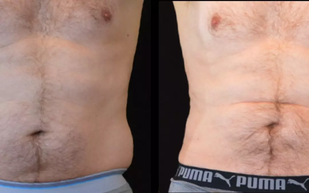 Understanding Trunk Liposuction: A Comprehensive Guide