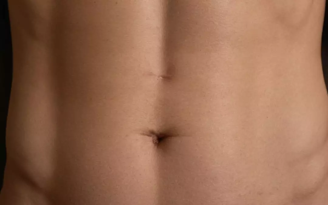 Narben Fettabsaugung Bauch: Was Sie wissen m&uuml;ssen