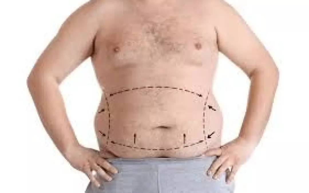 Upper Body Liposuction: What You Need to Know