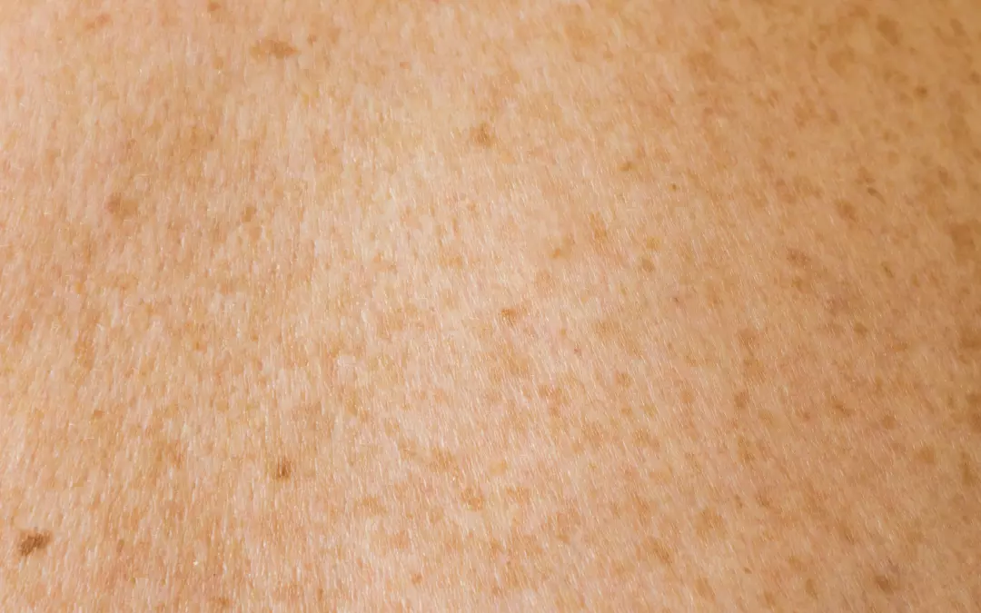 Stosswellentherapie Cellulite Vorher Nachher: Ein Umfassender &Uuml;berblick