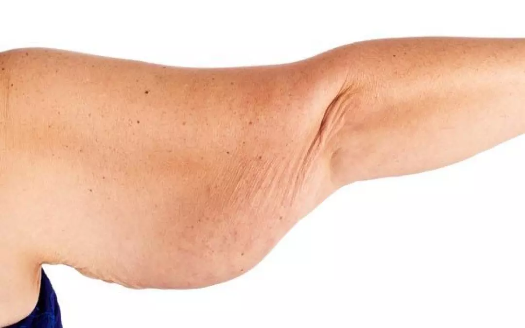 Comprehensive Guide to Bat Wing Arm Removal