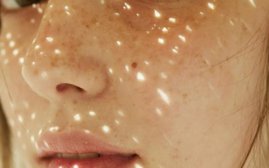 Todo Sobre Celulitis y Estr&iacute;as: Informaci&oacute;n y Consejos