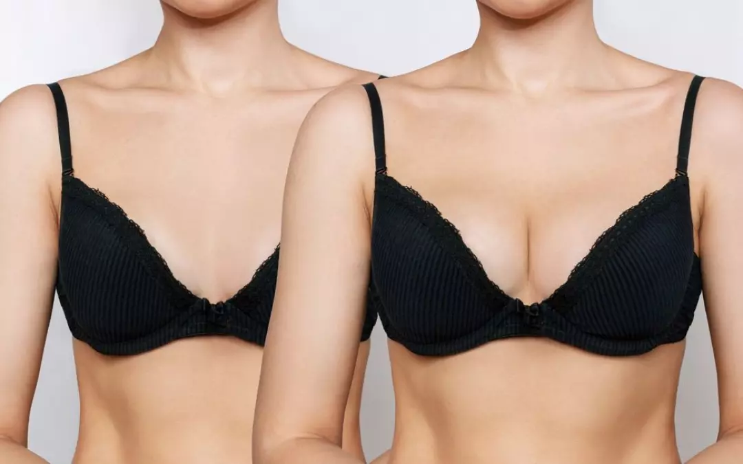 Natural Fat Transfer from Belly to Breast: Insights