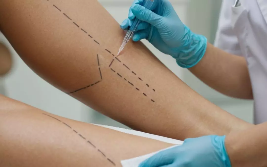 Waden Fettabsaugen: Alles, was Sie wissen m&uuml;ssen