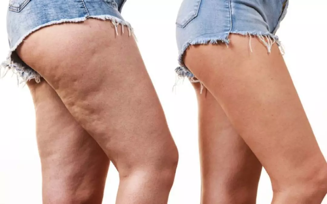 Lip&ouml;dem Symptome: Anzeichen und Diagnose