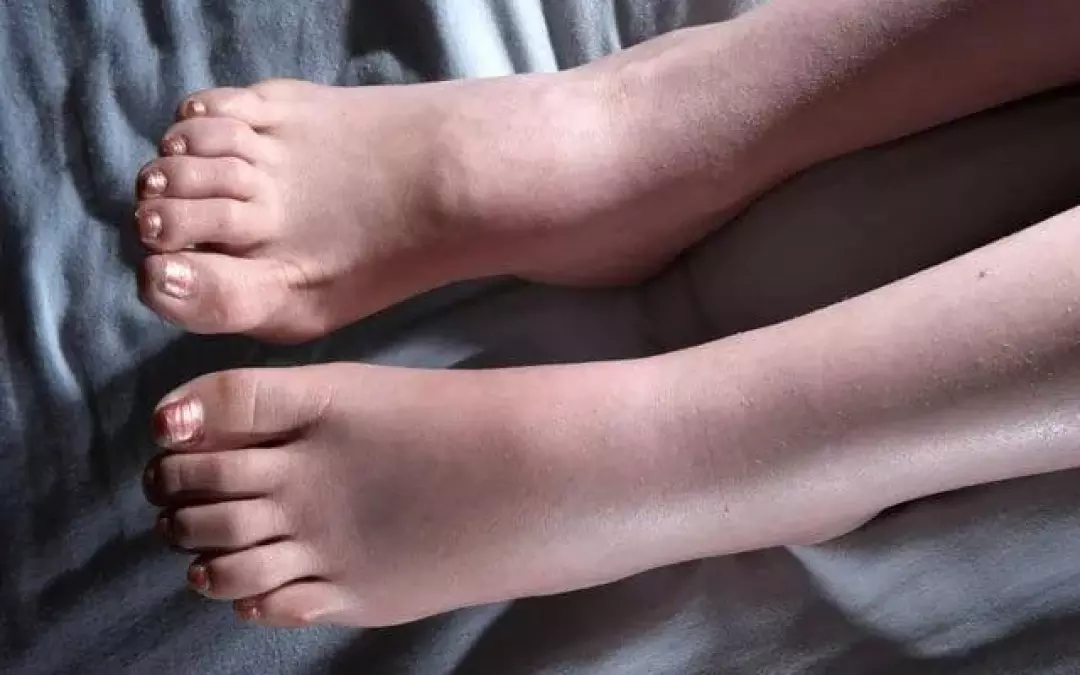 Wasser in den Beinen: Ab wann wird es gef&auml;hrlich?