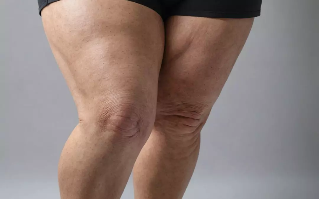 Alles &uuml;ber Lip&ouml;demtherapie: Ursachen, Symptome und mehr