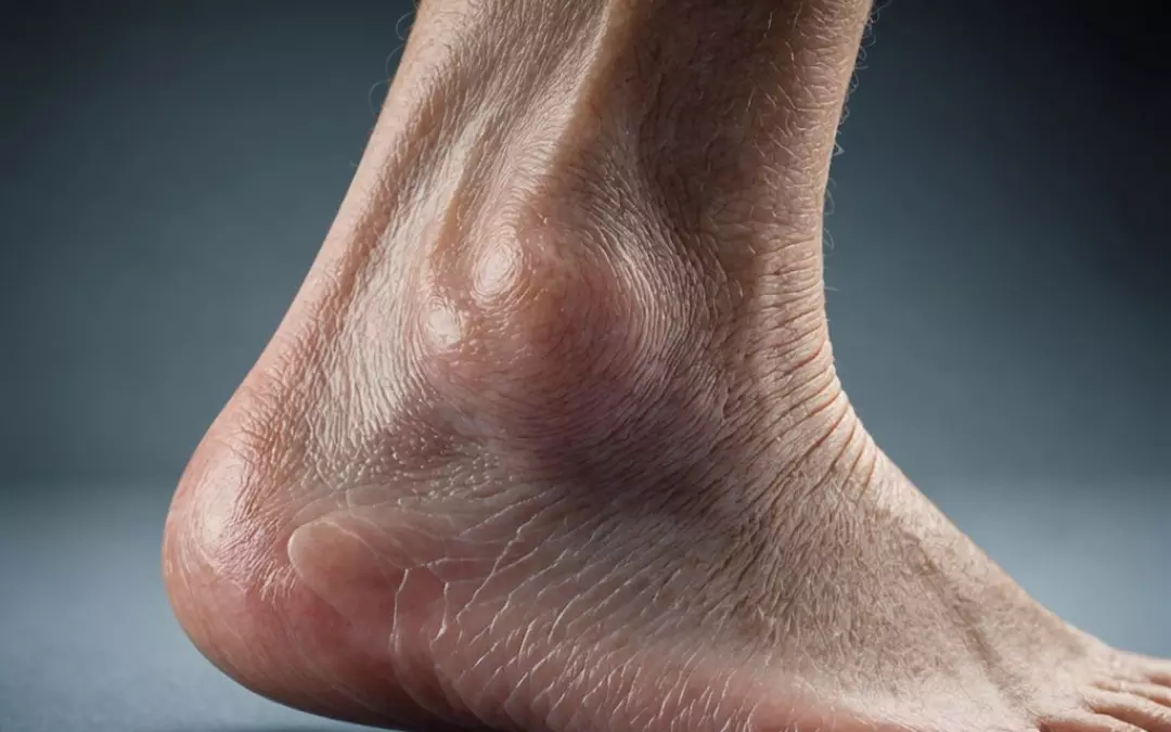 Lip&ouml;dem geschwollene Kn&ouml;chel: Alles, was Sie wissen m&uuml;ssen