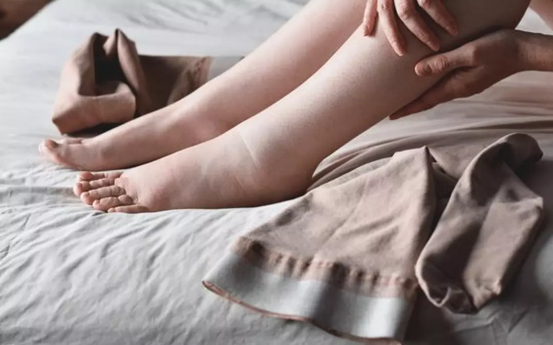 Str&uuml;mpfe bei Lymph&ouml;dem: Alles, was Sie wissen m&uuml;ssen