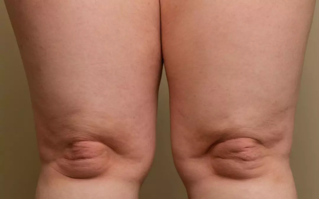 Kalte Beine Lip&ouml;dem: Symptome und Behandlungsm&ouml;glichkeiten