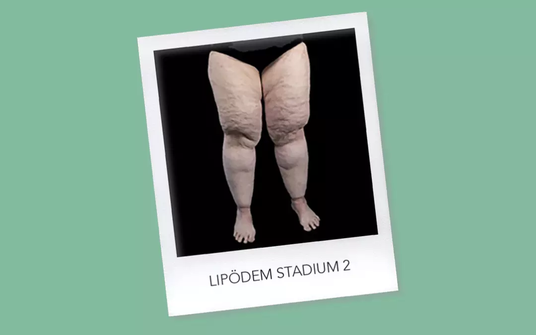 Lip&ouml;dem Stadium 2: Symptome und Empfehlungen