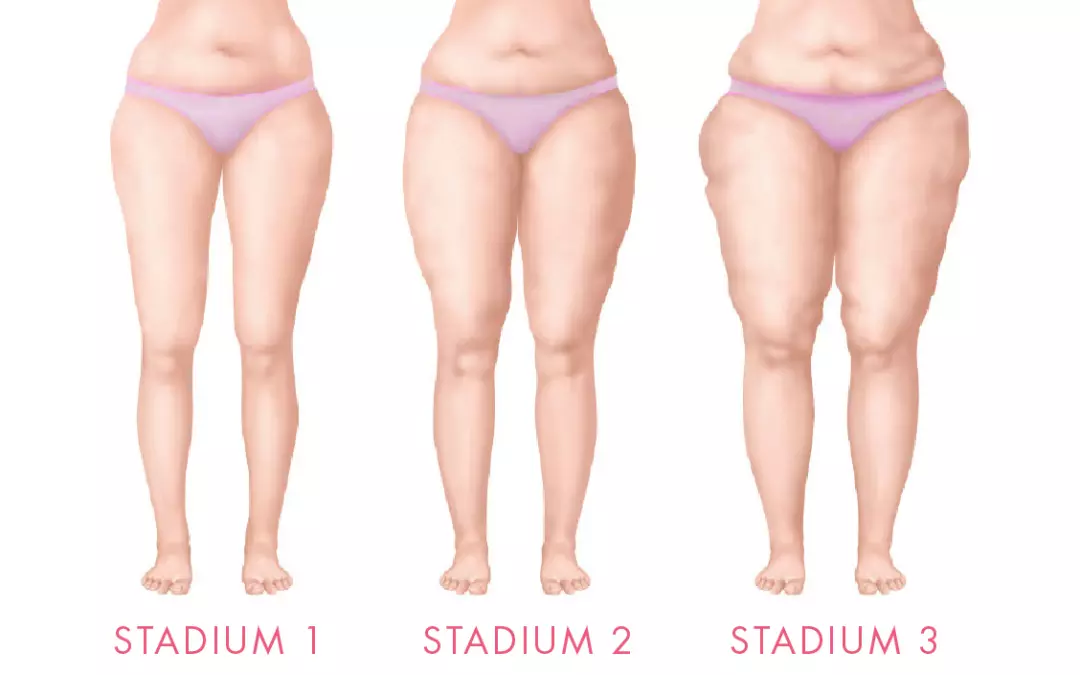 Stadien des Lip&ouml;dems