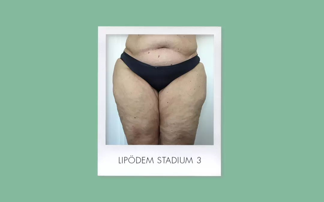 Lip&ouml;dem Stadium 3: Symptome und Empfehlungen