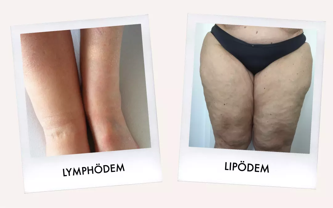 Lip&ouml;dem oder Lymph&ouml;dem: Was ist der Unterschied?