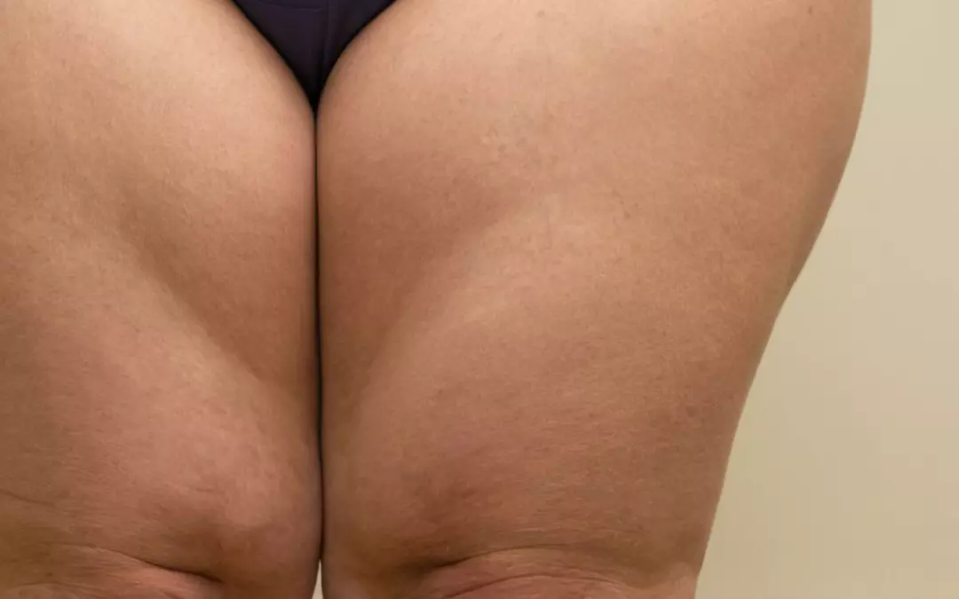 Lip&ouml;deme Beine: Symptome, Ursachen und Therapie