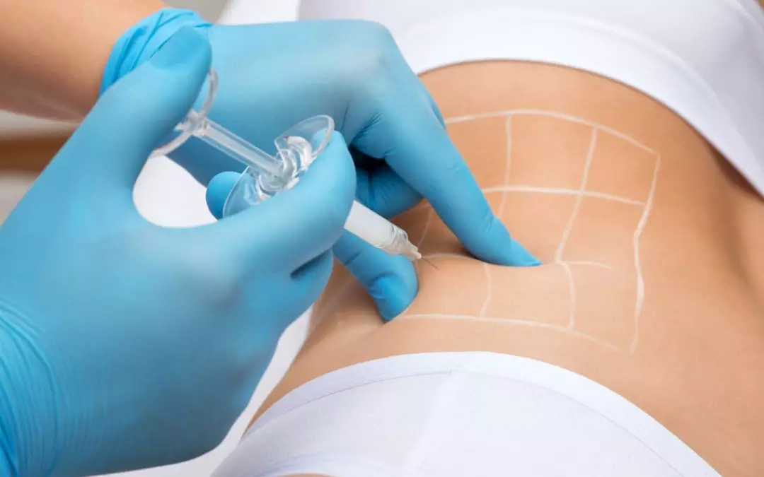 Lipolyse Injektion: Ihr umfassender Leitfaden