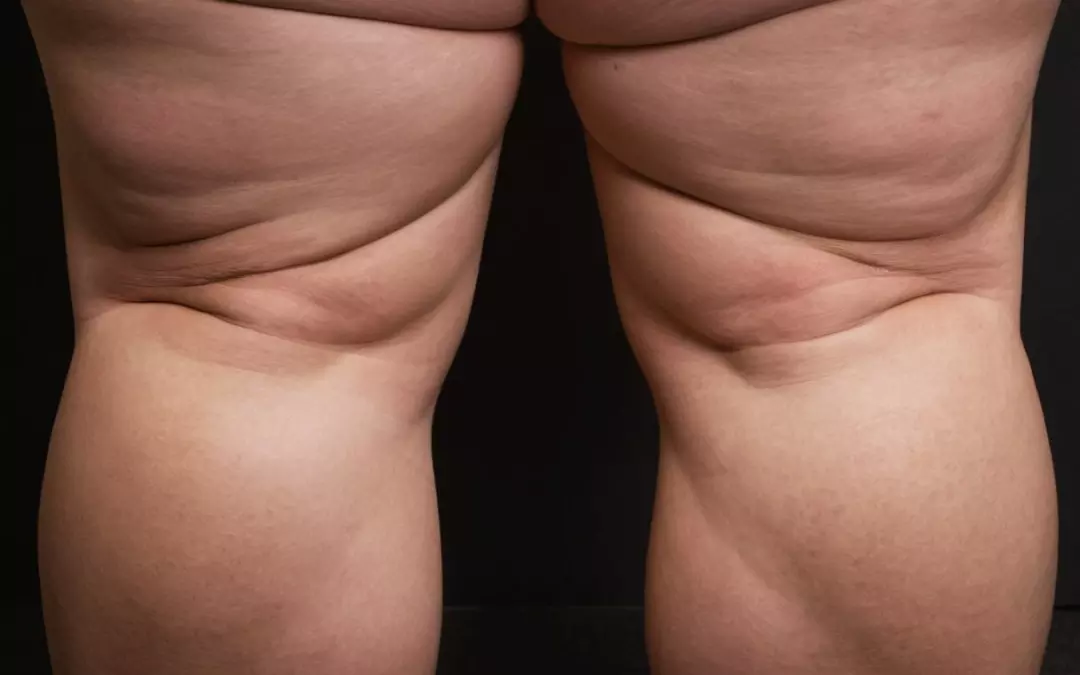 Lip&ouml;dem Waden: Ursachen und Behandlungsoptionen