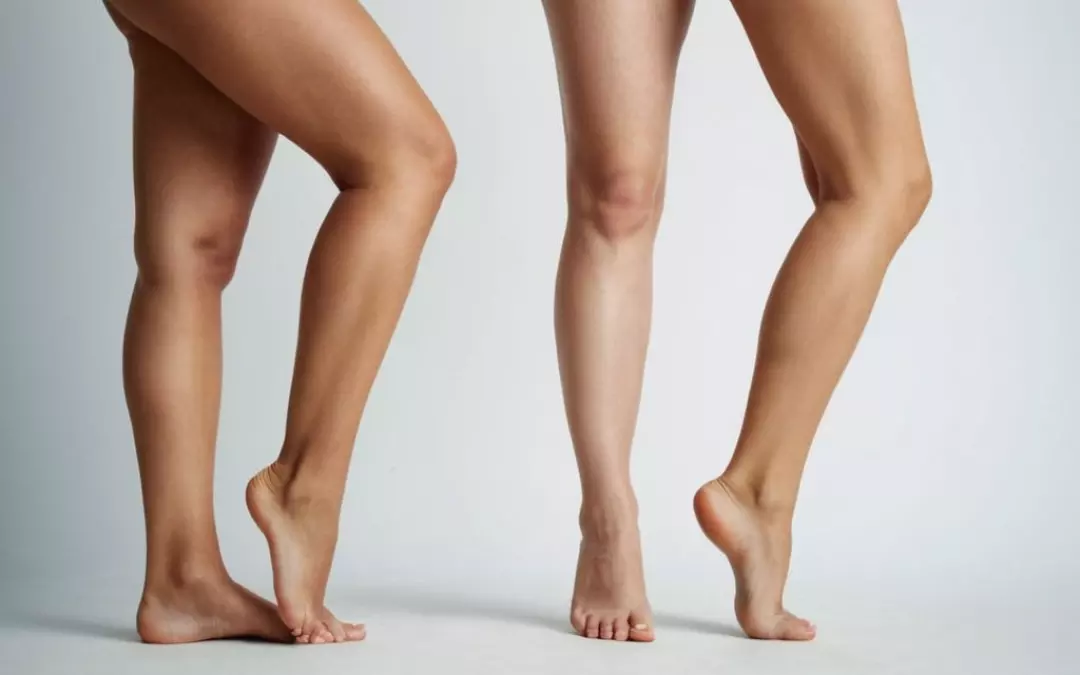 Dicke Beine oder Lip&ouml;dem - Wie unterscheidet man sie?