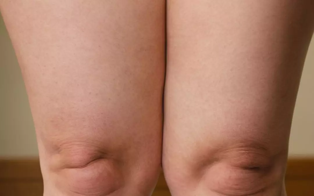 Vereinigung Lip&ouml;dem Schweiz: Ein umfassender Leitfaden