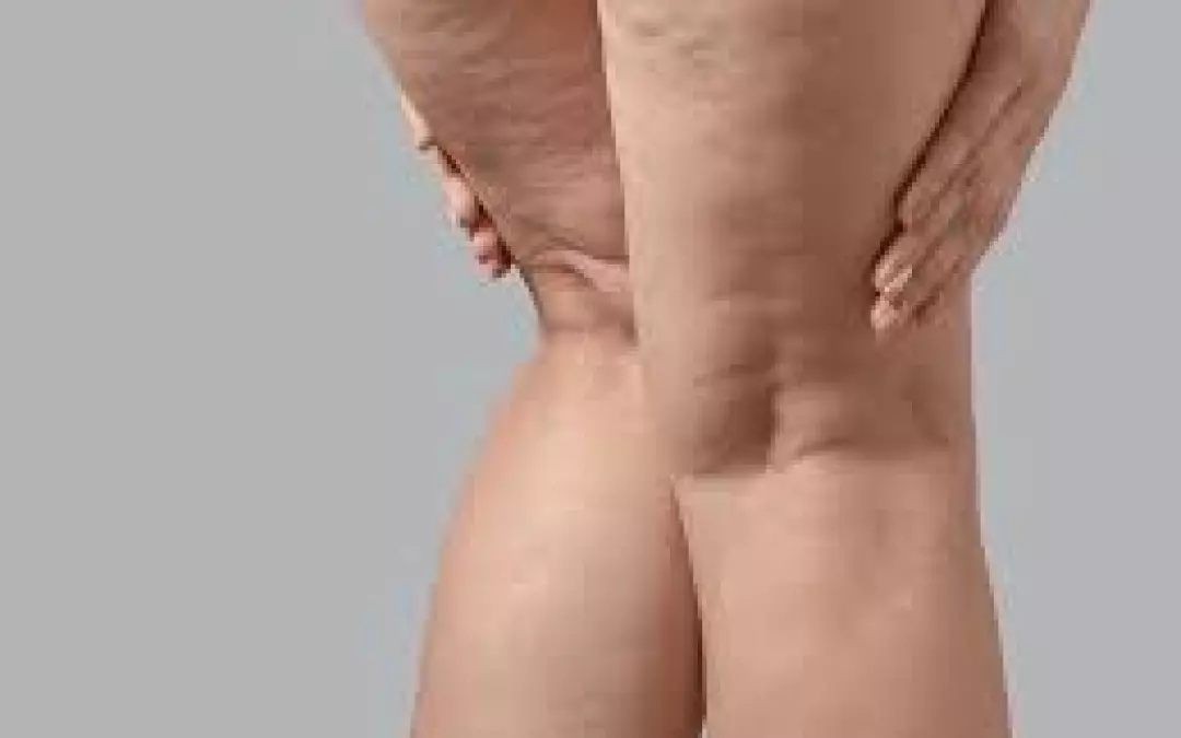 Kryolipolyse Lip&ouml;dem Erfahrung: Ein umfassender Leitfaden