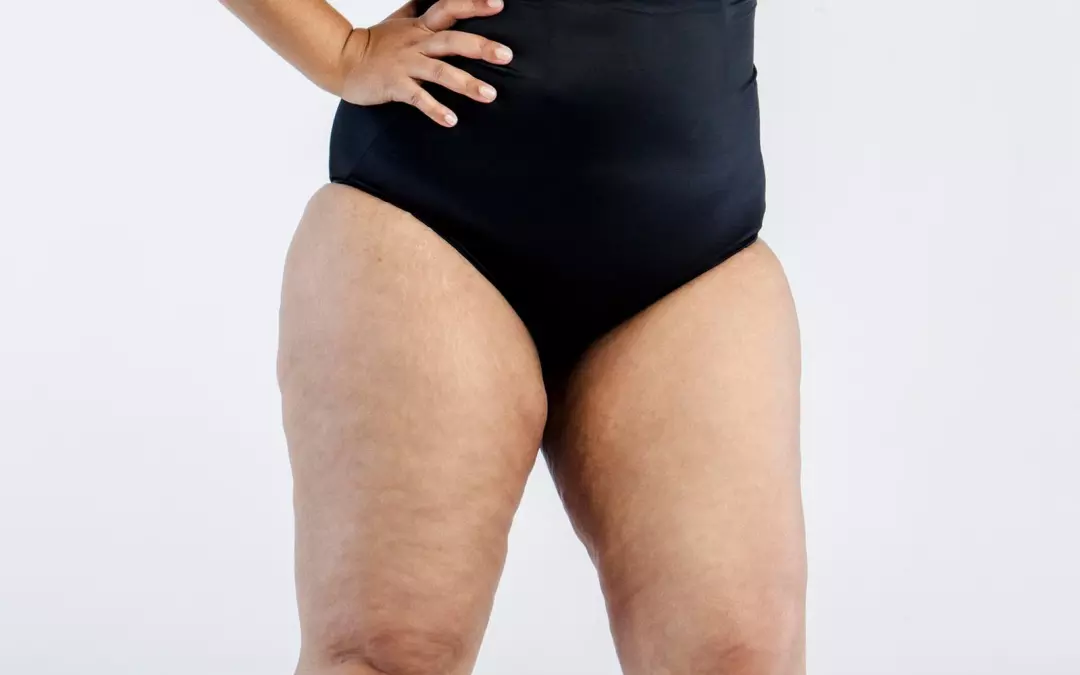 Lip&ouml;dem schlank: Symptome und L&ouml;sungen