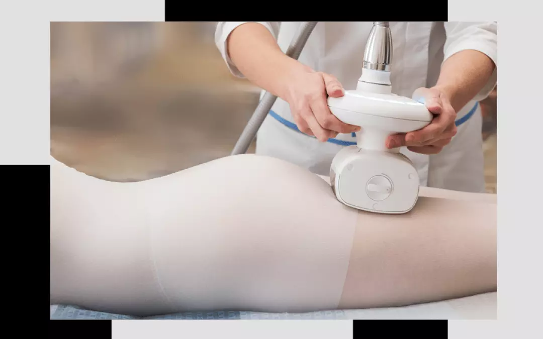 LPG Massage - Effektiv gegen Cellulite