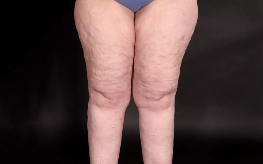 Lip&ouml;deme Beine: Ursachen und effektive Therapien