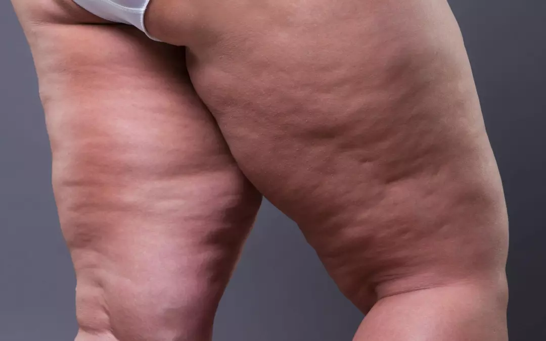 Alles &uuml;ber Lip&ouml;dem Klinik: Behandlung und Symptome