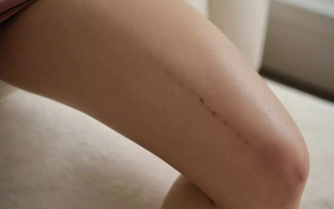 Schmerzen in der Kniekehle: Was nach der Venen OP tun?