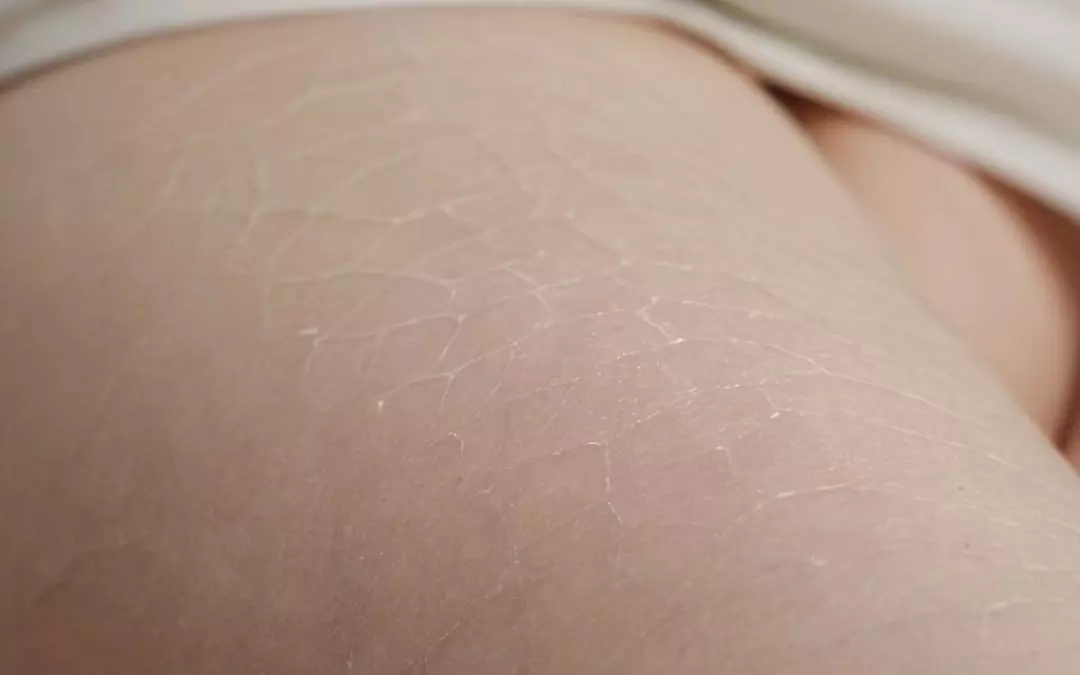 Besenreiser entfernen: Was zahlt die private Krankenkasse?